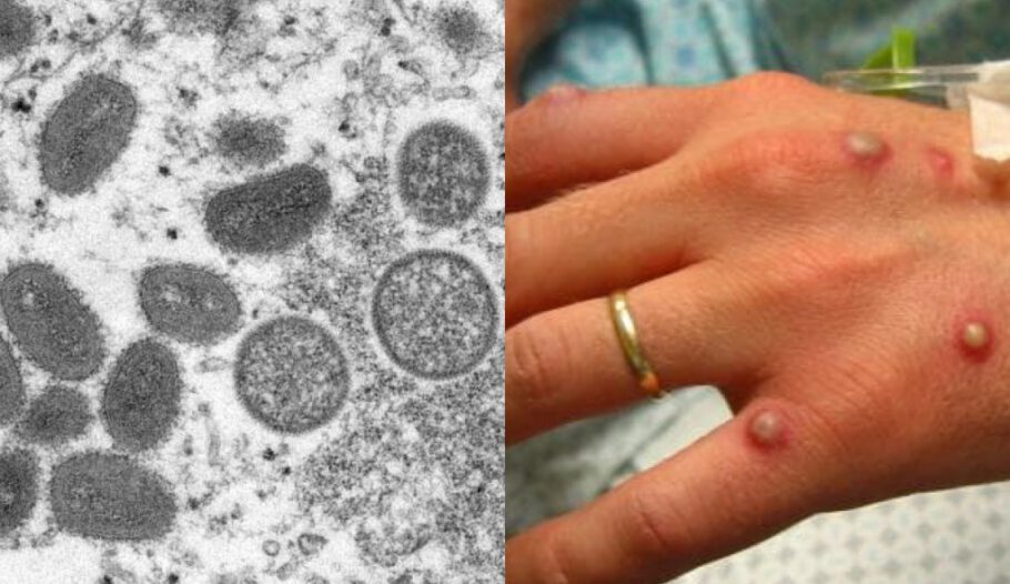 Confirmados cinco casos de varíola dos macacos em Portugal