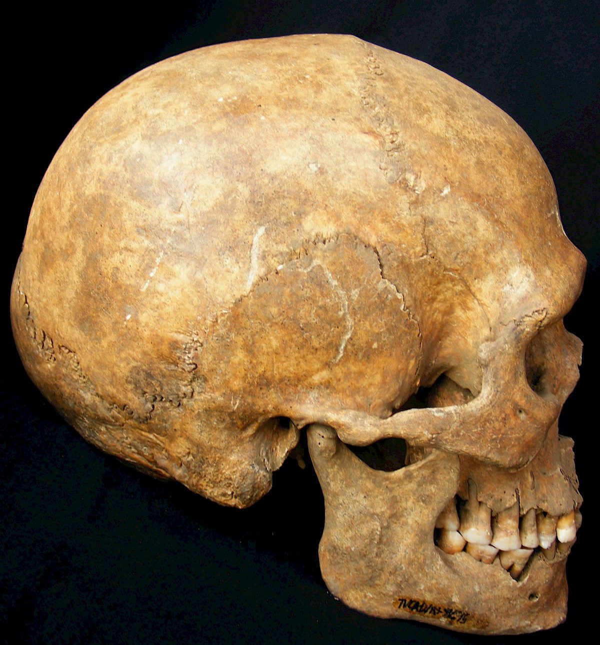 Identificada anomalia genética rara em homem que viveu em Bragança há mil anos